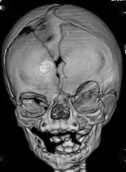 CT-scan of the skull of a person with coronal synostosis, orbital hypertelorism, and facial asymmetry as part of craniofrontonasal dysplasia.