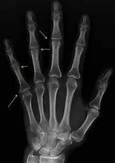 X-ray of subtle calcifications in CREST syndrome