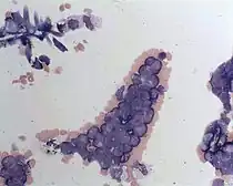 Lymphoma cells in cerebrospinal fluid, cytocentrifuge slide