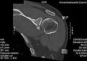 CT scan showing a bony Bankart lesion at the antero-inferior glenoid