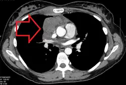 CT chest of a person with lymphoma showing large lymph nodes in the chest