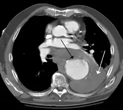 Contrast enhanced CT of a ruptured large (7 cm) thoracic aneurysm, with black arrow indicating the aorta, and white arrow blood in the thorax