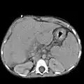 Liver cirrhosis as seen on a CT of the abdomen in transverse orientation