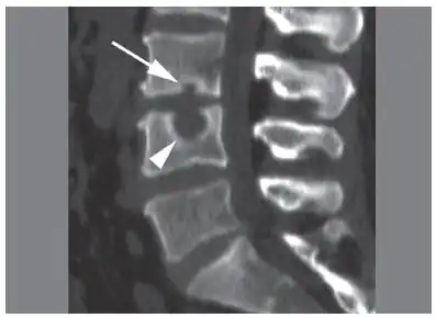 CT scan in the sagittal plane of two Schmorl's nodes. The small Schmorl's node at the inferior endplate of the L3 vertebral body (arrow) has typical features, being broad-based at the endplate, with well-defined contours and thin marginal sclerosis. A large and less typical Schmorl's node (arrowhead) is observed at the superior endplate of L4.