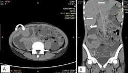 Lymphoma may appear as peritoneal lymphomatosis, as can be seen on CT scan. Image depicts non-Hodgkin lymphoma in a 17 year old who is HIV positive. A. Irregular homogenously enhancing wall thickening involving the ileocaecal region with aneurysmal dilatation of involved segments (curved arrow). B. Hepatosplenomegaly with liver metastasis (white arrows).