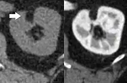 CT scan of a renal angiomyolipoma. It involves the renal cortex, and has an attenuation of less than 20 HU on the Hounsfield scale, which are typical characteristics.