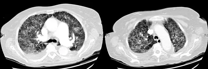 CT, showing extensive pulmonary parenchymal involvement consisting of irregular septal thickenings with ground-glass areas and centrilobular nodules with a peri-lymphatic distribution