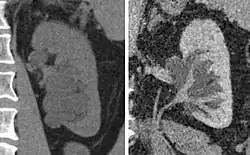 Peripelvic renal cysts may look like hydronephrosis on non-contrast CT (left image). However, CT urography (at right) reveals non-dilated calyces and pelvises.