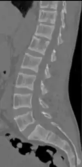 CT scan of the same case.