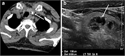 CT of thyroid colloid nodule with calcification