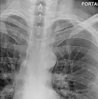 Upright chest radiography showing mediastinal air adjacent to the aorta and tracking cephalad adjacent to the left common carotid artery.  This patient presented to the Emergency department with severe chest pain after eating.