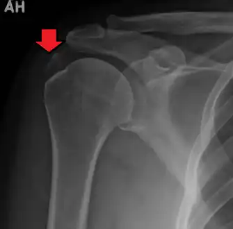 An x-ray showing calcific deposits in the area of the tendons of the rotator cuff muscles