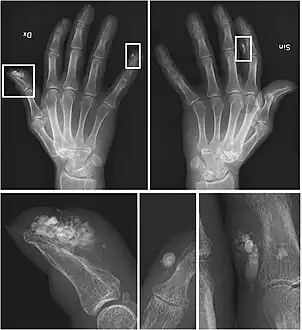 X-rays showing calcinosis in a woman with CREST syndrome