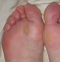 Calluses (plantar in right foot and medial in left foot)