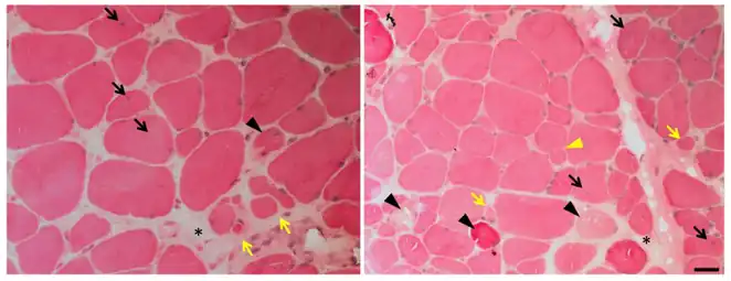 Photomicrograph of muscle affected by calpainopathy. Seen in these views are endomysial fibrosis (black asterisks), central nuclei (black arrows), fiber splitting (yellow triangle), necrosis (black triangles), atrophic fibers (yellow arrows), and increased variation in size and shape.