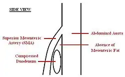 A diagram of a compressed duodenum due to a reduced mesenteric angle.