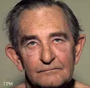 The same man with no swelling in his face
