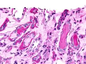 Micrograph showing myeloma cast nephropathy in a kidney biopsy: Hyaline casts are PAS positive (dark pink/red - right of image).  Myelomatous casts are PAS negative (pale pink - left of image), PAS stain.