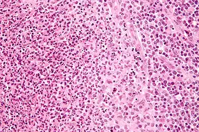 High-magnification micrograph of CSD showing a granuloma (pale cells - right of center on image) and a microabscess with neutrophils (left of image)