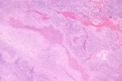 Micrograph of a lymph node affected by cat scratch disease.