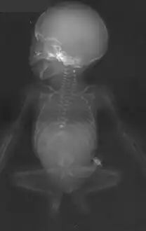Antero-posterior radiographic view, showing missing ribs, absent lumbosacral vertebrae, hypoplastic pelvis and "frog-like" position of the lower extremities