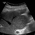 caudate lobe hypertrophy in ultrasound due to cirrhosis