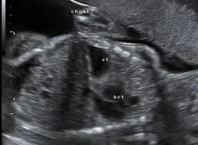 Congenital diaphragmatic hernia: coronal obstetric ultrasound (head to right of image, thorax centre, abdomen left) shows the stomach and heart both within the thorax.