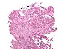 Cancer – Invasive adenocarcinoma (the most common type of colorectal cancer). The cancerous cells are seen in the center and at the bottom right of the image (blue). Near normal colon-lining cells are seen at the top right of the image.