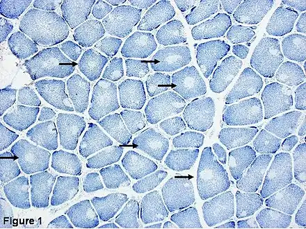 Histopathologic appearance of typical central core disease: NADH-TR, transverse section from the rectus femoris. Marked predominance of dark staining, high oxidative type 1 fibres with cores affecting the majority of fibres. Cores are typically well demarcated and centrally located (→), but may occasionally be multiple and of eccentric location.