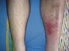 Redness and mild swelling of an adult leg