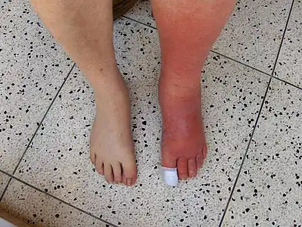 Example of cellulitis showing 3+ edema of left leg