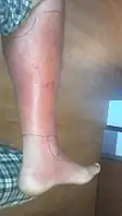 Cellulitis of the leg with foot involvement.