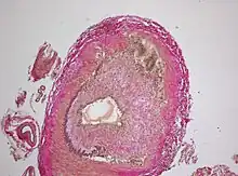 Histopathology of giant cell vasculitis in a cerebral artery. Elastica-stain.