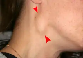 Swelling of the right neck from the spread of oral cancer.