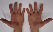 Rash on palms of the hands.
