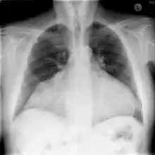Chest X-ray: unusual heart contour due to a heterotopic heart transplantation. There is a native heart with a left ventricular aneurysm on the left, and the slightly smaller donor heart next to it on the right.
