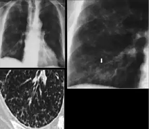 Chest x-ray showing nodule with margins that are indistinct or poorly defined (tree-in-bud sign) in post-primary pulmonary TB.