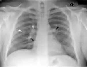 Chest x-ray showing discrete round nodule(s) with round edges without calcification, after secondary tuberculosis.