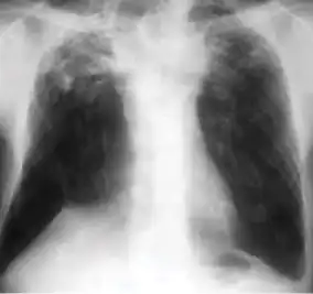 Chest x-ray showing fibrocalcific scar after secondary tuberculosis as air-space opacification or haziness between or surrounding these densities.