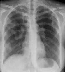 Chest x-ray showing patchy opacification on the upper right and mid-zone lung with fibrotic shadows, as well as bilateral hilar lymphadenopathy.