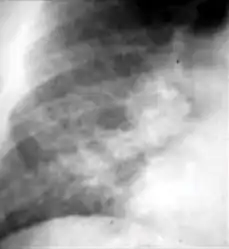 Chest x-ray showing coarse reticulonodular densities on the lower right lung of post-primary pulmonary TB.