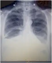 Chest X-ray showing bilateral chylothorax