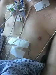 Chest scar after heart transplant