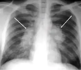 Chest x-ray showing bilateral hilar adenopathy of primary pulmonary TB
