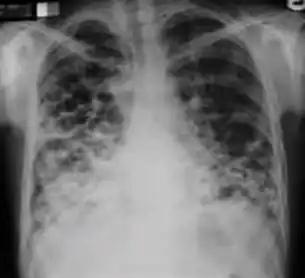 Chest x-ray showing course bronchiectasis of the lungs post-primary pulmonary tuberculosis.