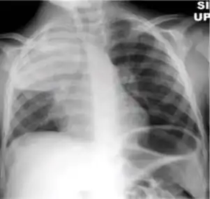 Chest x-ray showing nodular densities with distinct borders and no surrounding airspace opacification, with a reduction in the space occupied by the upper lobe.