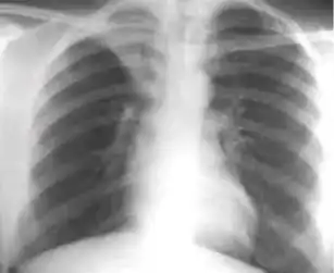 Chest x-ray showing distinct fibrotic scar with volume loss or retraction with an upward deviation of the fissure or hilum on the corresponding side with asymmetry of the volumes of the two thoracic cavities.