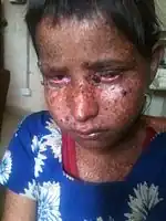 Child with xeroderma pigmentosum in Nepal