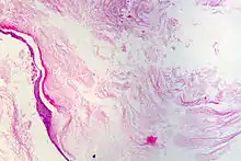 Cholesteatoma as seen during microscopic examination