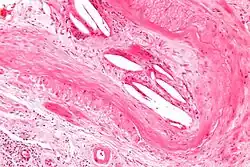 Micrograph of a cholesterol embolus showing the characteristic cholesterol clefts and a giant cell reaction.